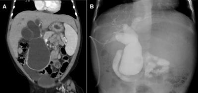 Case report: Severe hepatic fibrosis induced by chronic cholestasis of congenital biliary dilation treated by laparoscopic surgery after immunonutrition support– An infantile case